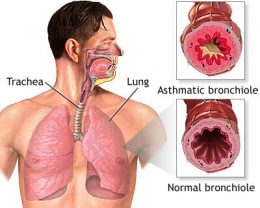 br-asthma